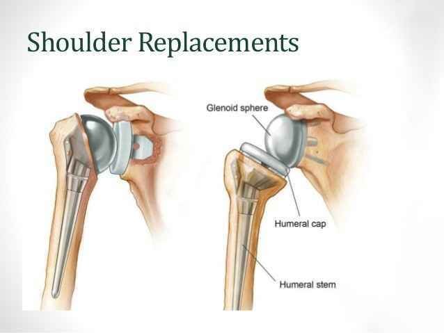 Why Is Shoulder Replacement Recommended ?